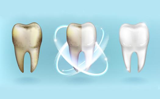 Noticia Blanqueamiento dental: ¿Cómo iluminar tu sonrisa?