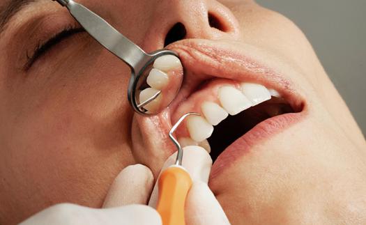 Noticia El curetaje dental: un tratamiento preventivo