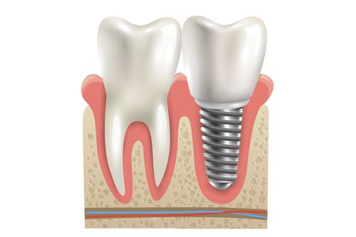 Implantes dentales