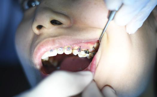 Noticia La ortodoncia con brackets 